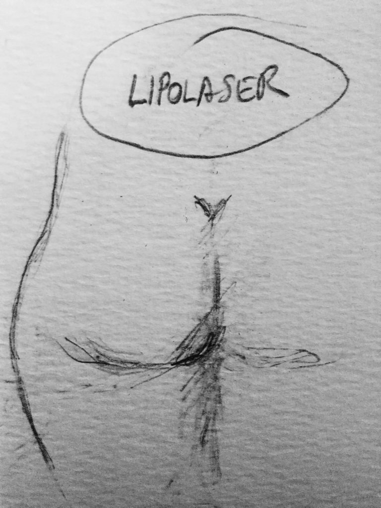 lipolaser